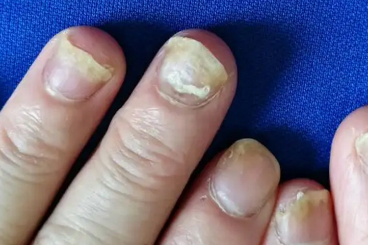 甲银屑病甲母质受损图 甲银屑病甲母质受损图