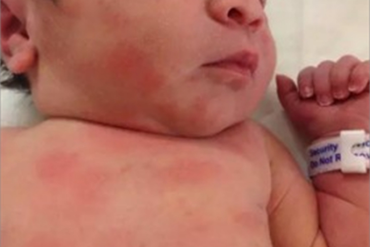 毒性红斑全身长红斑图