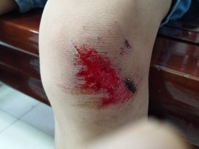 跌伤膝盖上有大面积伤口伴出血图.jpg