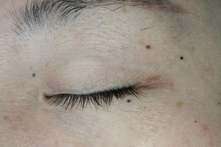 交界痣眼周痣图