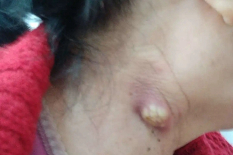 皮肤钙质沉着症颈部疙瘩图