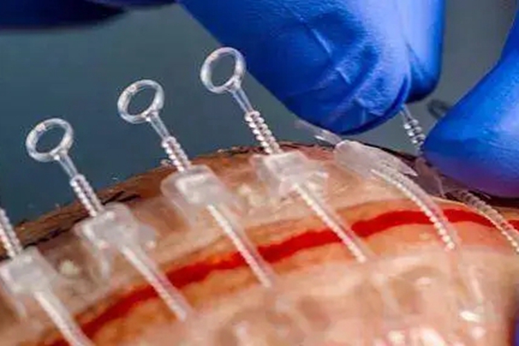 剖腹产拉链式缝合图 剖腹产拉链式缝合图