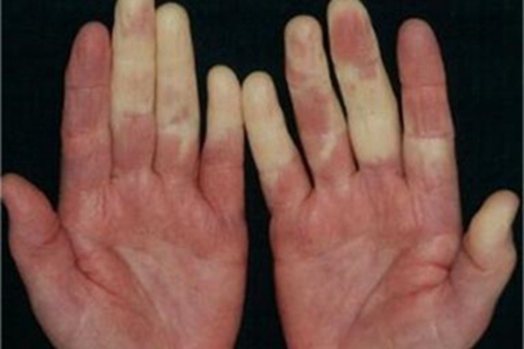 雷诺综合征发白图 雷诺综合征发白图