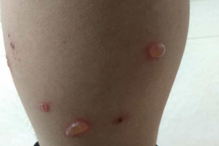 急性网状淋巴管炎小腿大水疱图 急性网状淋巴管炎小腿大水疱图