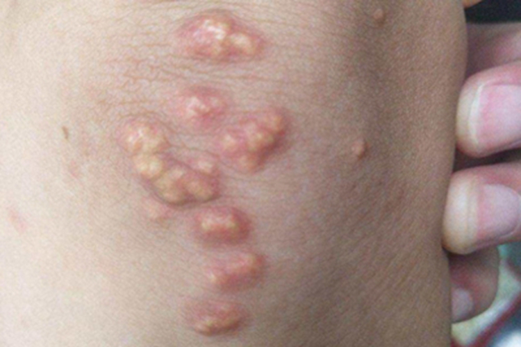 发疹性黄瘤胳膊小疙瘩图