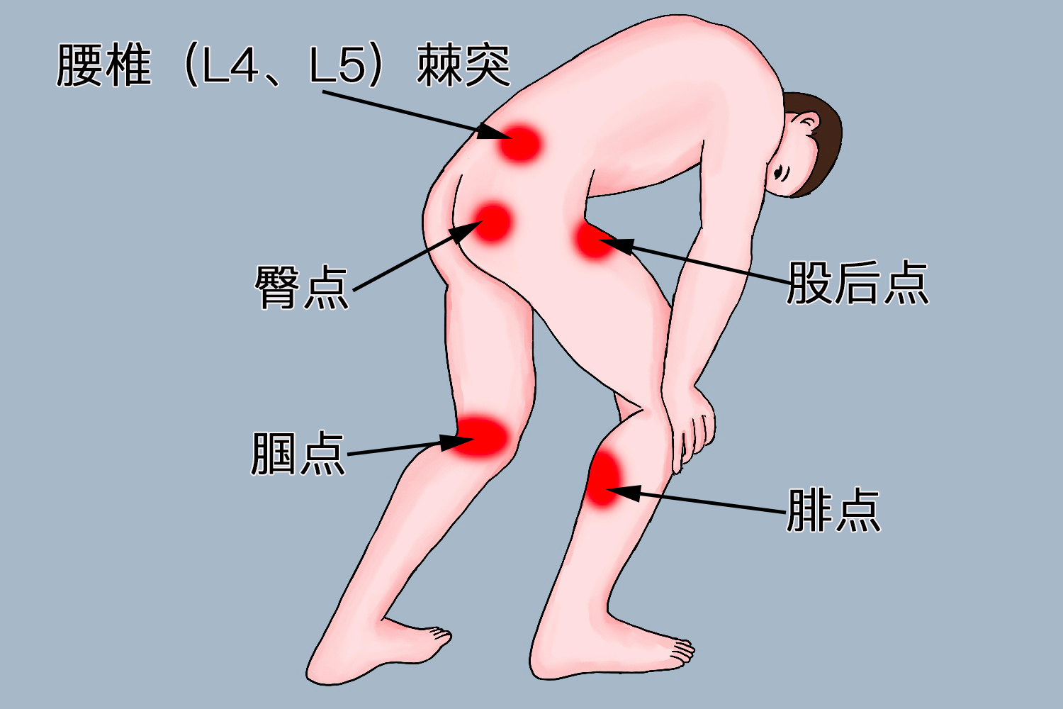 坐骨神经痛的疼痛部位图 坐骨神经痛的疼痛部位图