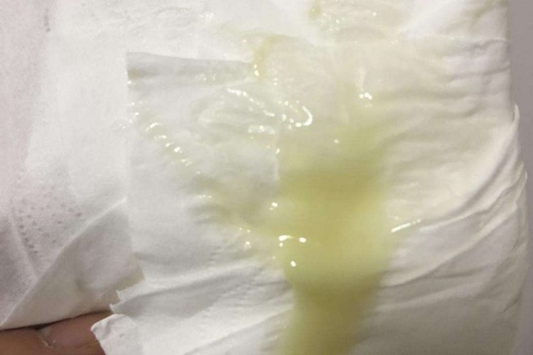 盆腔炎黄色分泌物图 盆腔炎黄色分泌物图