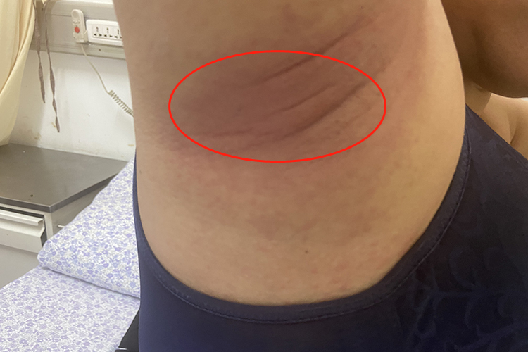 腋下慢性湿疹色素沉着图