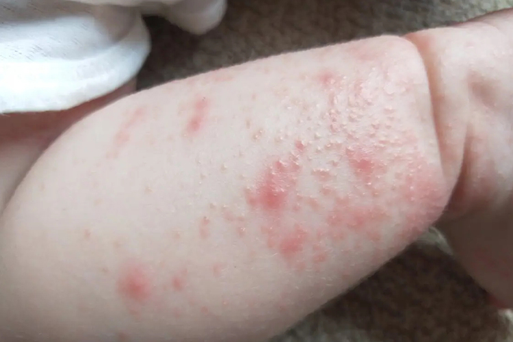 身上长急性湿疹图