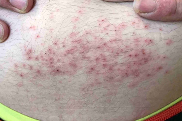 镍皮炎下腹红斑图 镍皮炎下腹红斑图