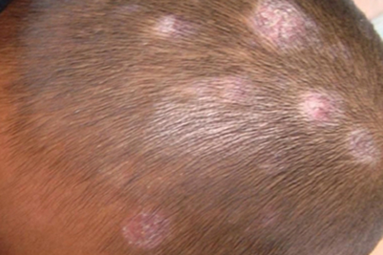 白色糠疹头皮症状图