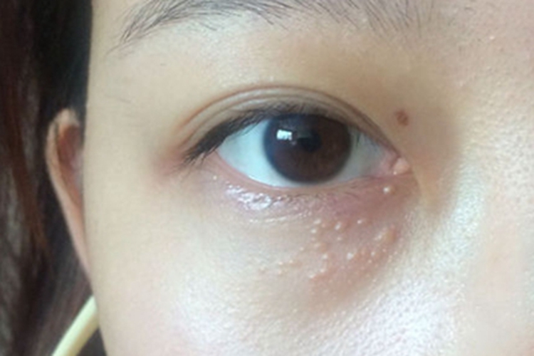 汗管瘤下眼睑一片肉疙瘩图