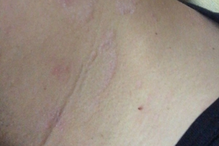 颈部假性皮萎缩侧颈白斑图 颈部假性皮萎缩侧颈白斑图