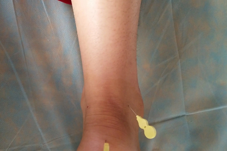 跟腱炎图 跟腱炎图