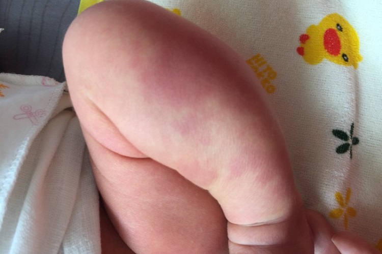 红斑狼疮紫斑图 红斑狼疮紫斑图