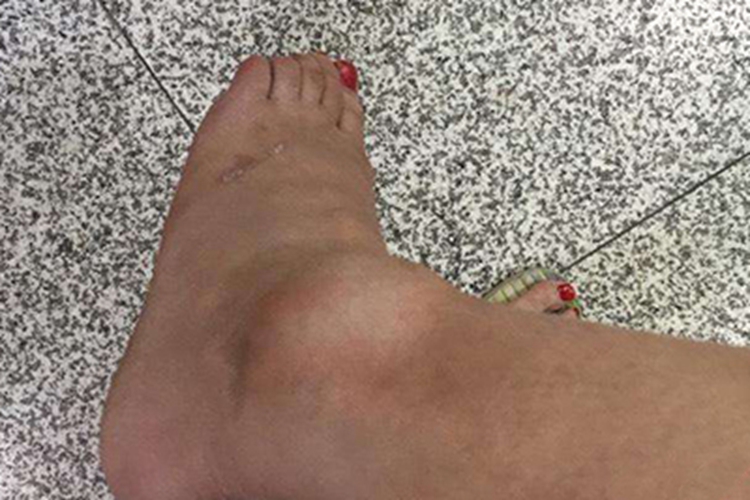 踝扭伤脚踝肿起个大疙瘩图