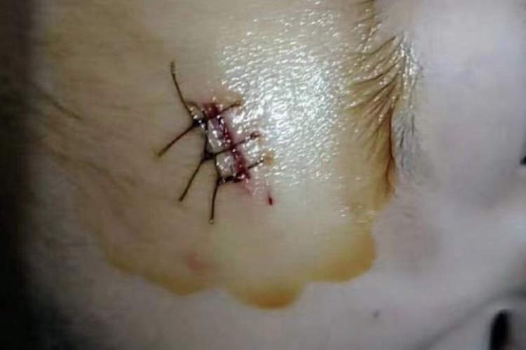 孩子额头缝针图