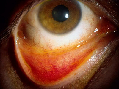 慢性细菌性结膜炎下眼睑里边发红图