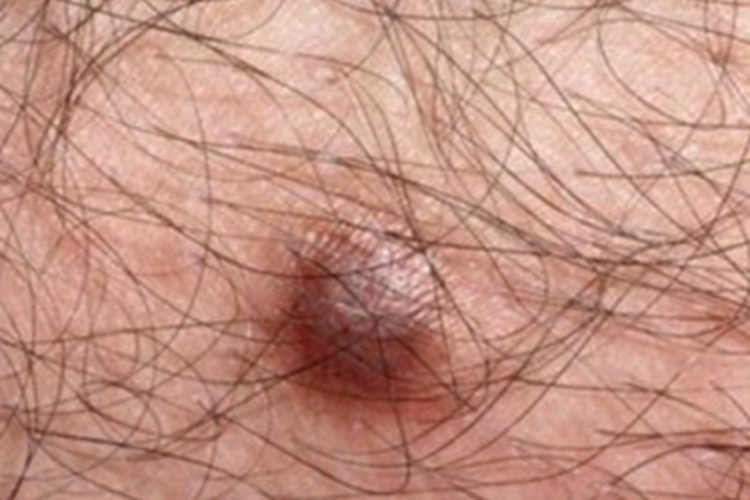 鲍温样丘疹病会阴部疙瘩图 鲍温样丘疹病会阴部疙瘩图