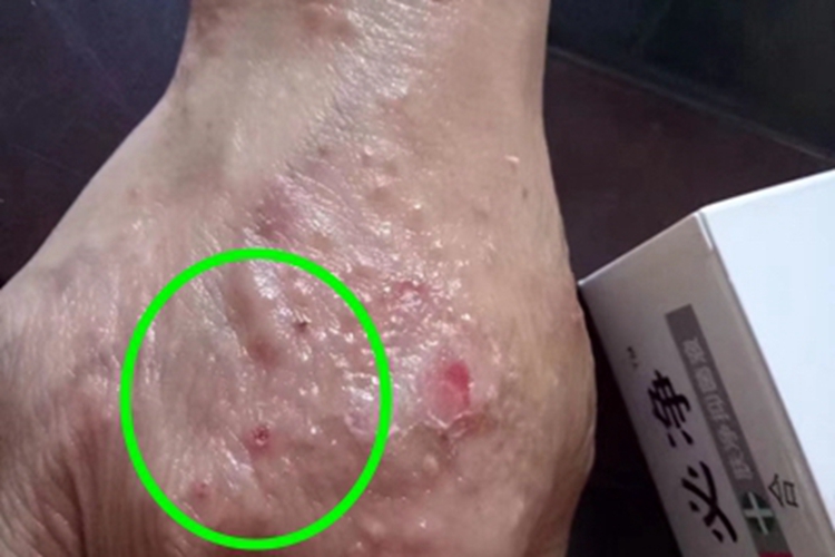 急性湿疹手背血痂图