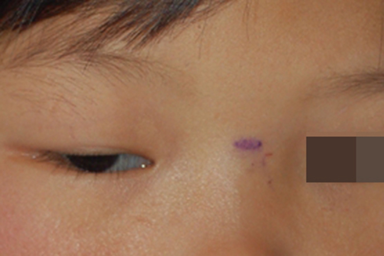 先天性上睑下垂重度图