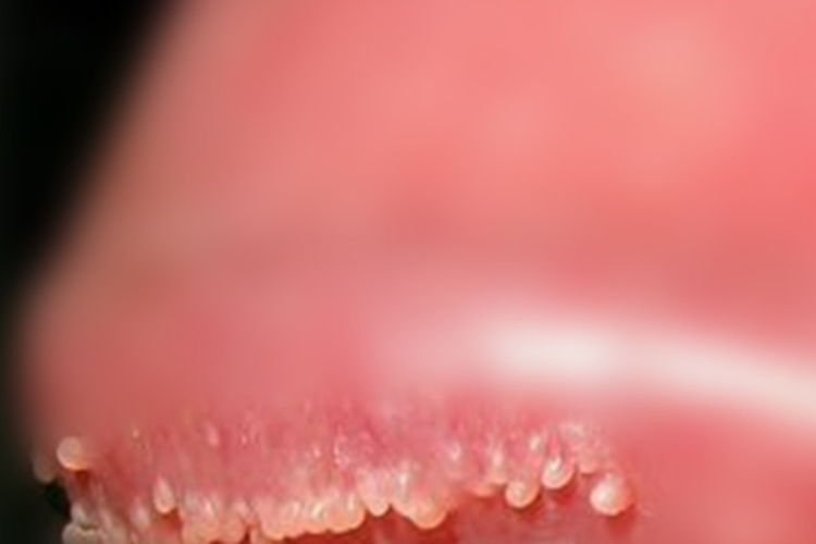 珍珠状阴茎丘疹冠状沟丘疹图 珍珠状阴茎丘疹冠状沟丘疹图