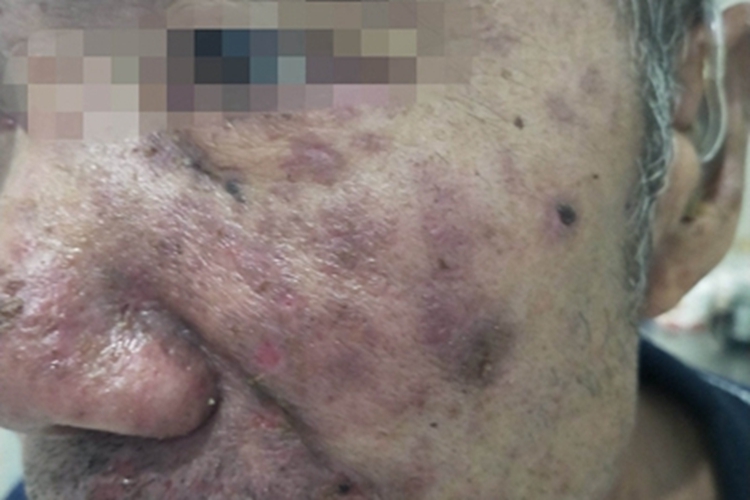 牛痘样水疱病非典型重型红斑图