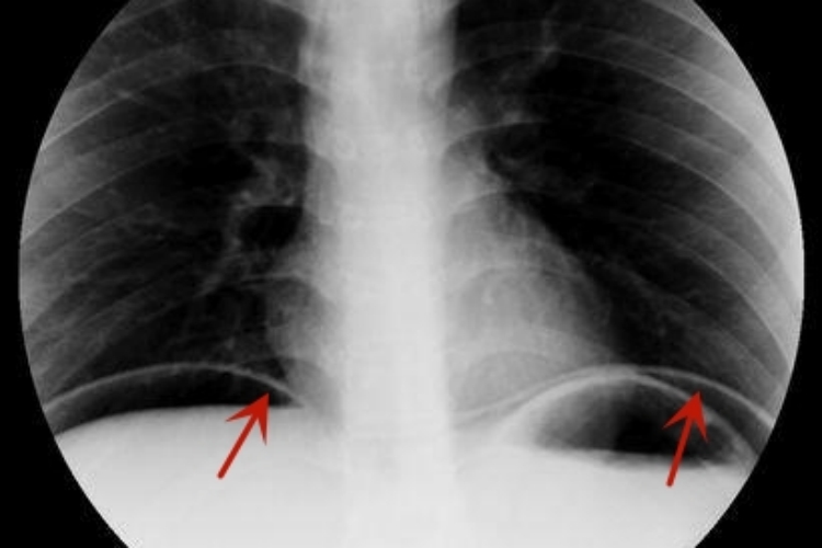 肠穿孔X线图 肠穿孔X线图