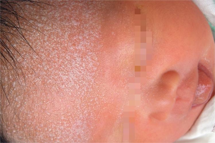 婴儿头面部粟粒疹图 婴儿头面部粟粒疹图