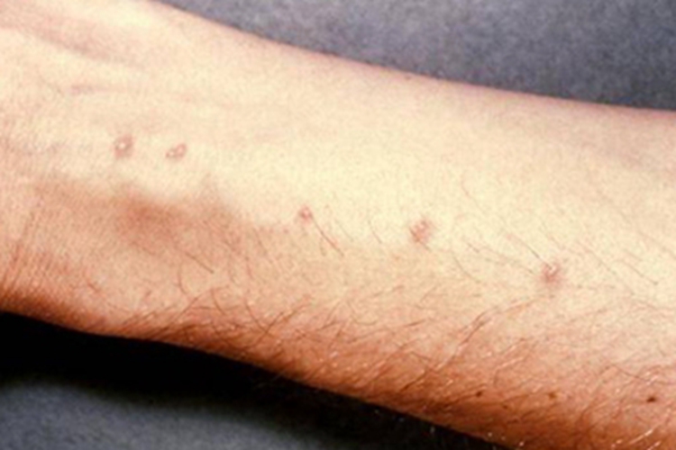 动物血吸虫尾蚴皮炎胳膊长疹子图