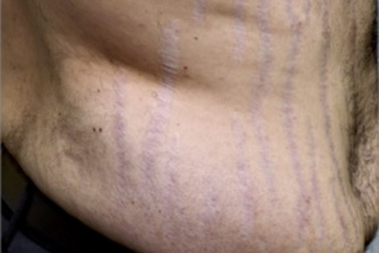 库欣综合征腹部紫纹图