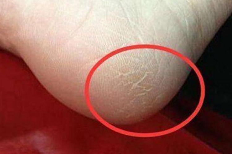 桥本甲状腺炎纹图