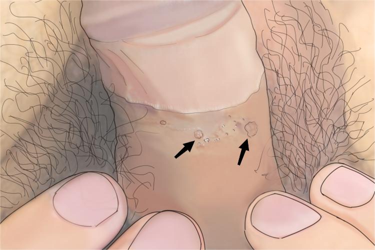 男性尖锐湿疣早期图