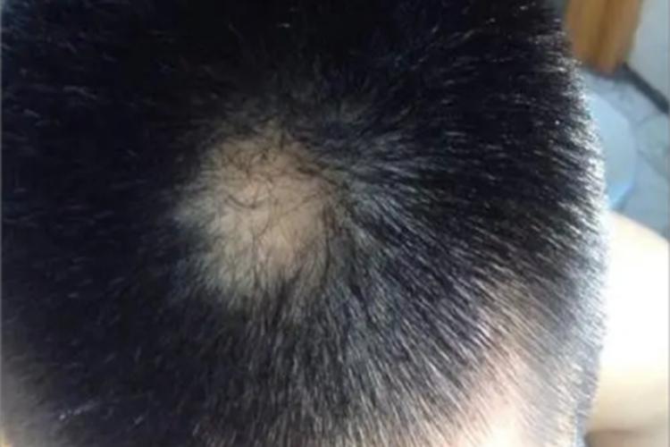 梅毒性脱发头皮有圆形斑块图