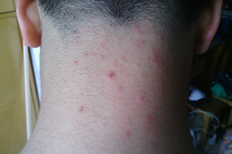 植物性皮炎后颈症状图 植物性皮炎后颈症状图