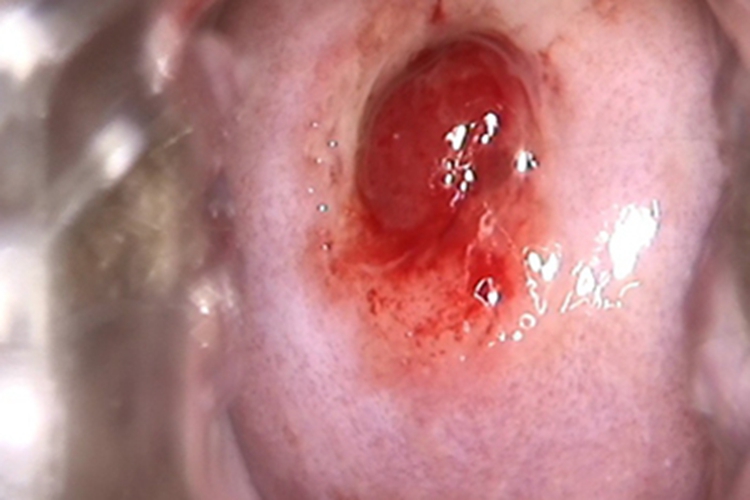 宫颈息肉症状图