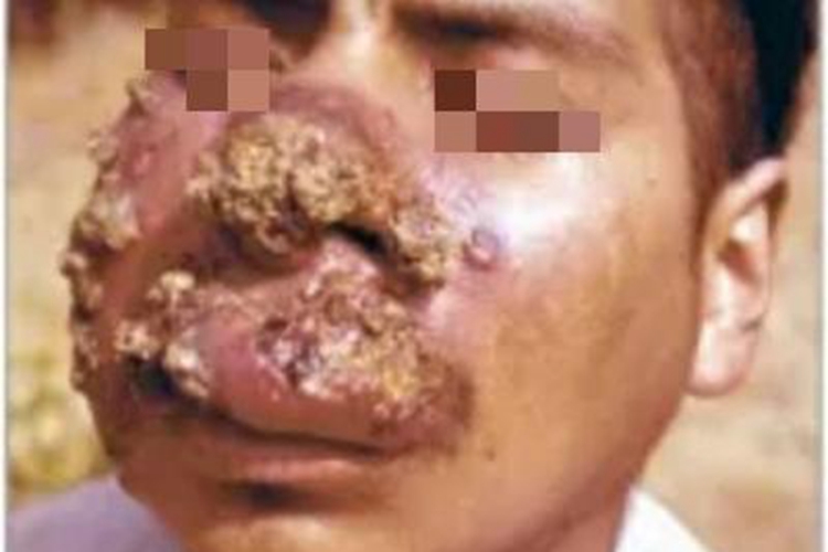 皮肤利什曼病面部结节图