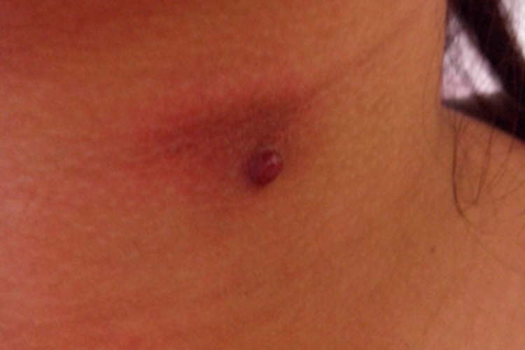 网状组织细胞肉芽肿症状图 网状组织细胞肉芽肿症状图