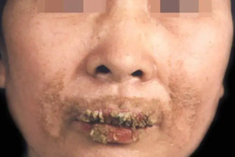 慢性黏膜皮肤念珠菌病嘴唇结痂图 慢性黏膜皮肤念珠菌病嘴唇结痂图