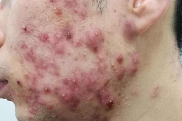 聚合性痤疮面部症状图