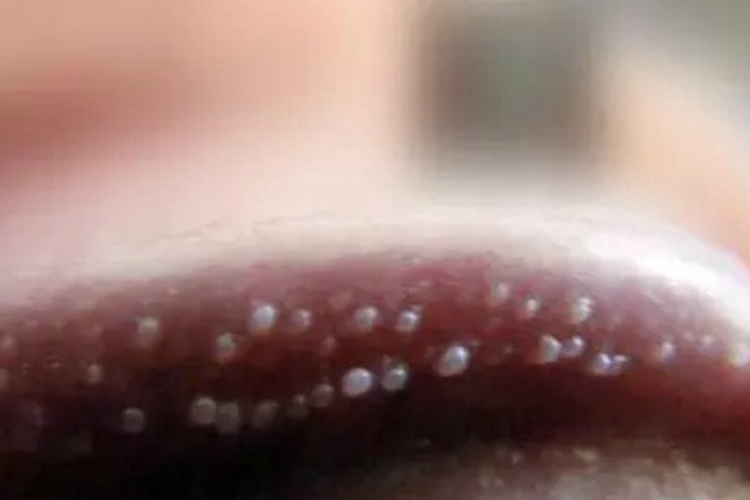 阴茎珍珠状丘疹图 阴茎珍珠状丘疹图