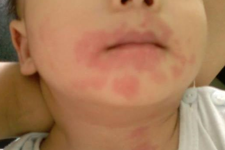 小孩嘴巴过敏症状图