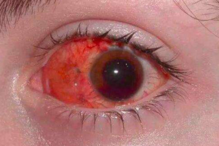 流行性角结膜炎眼角症状图