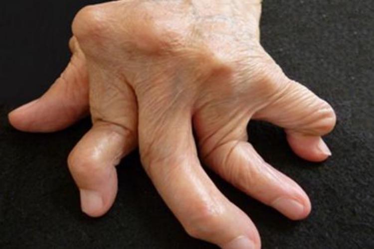 类风湿关节炎第二关节畸形图