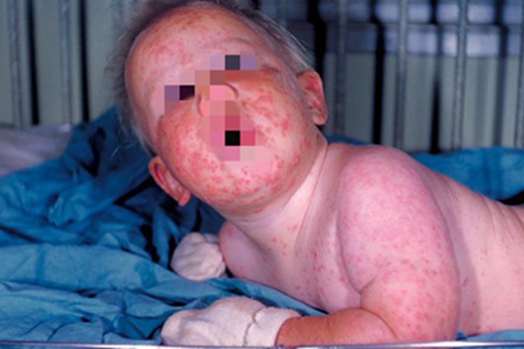 牛痘全身症状图