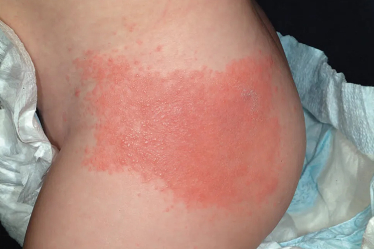 十个月宝宝接触性皮炎起红疙瘩图