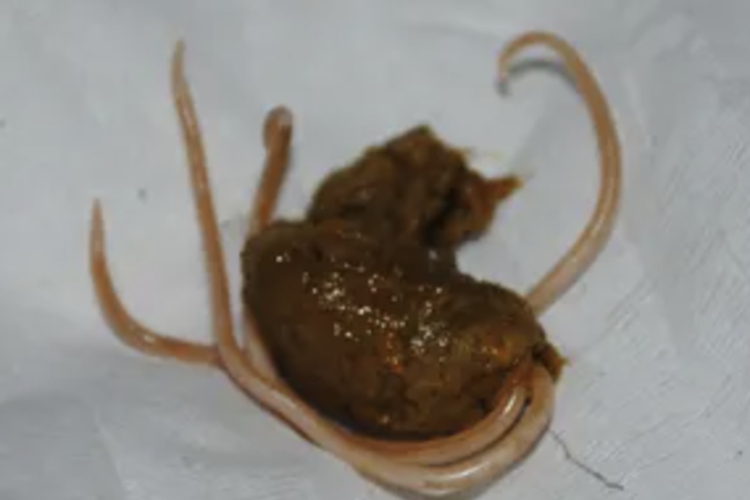 大便排出蛔虫图