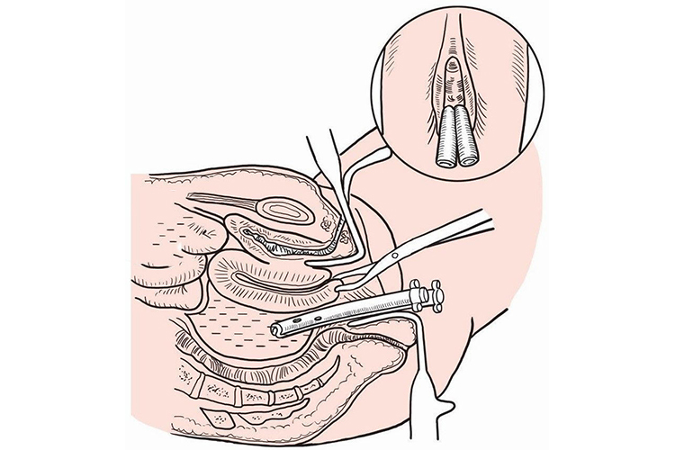经阴穿刺盆腔引流管位置图 经阴穿刺盆腔引流管位置图