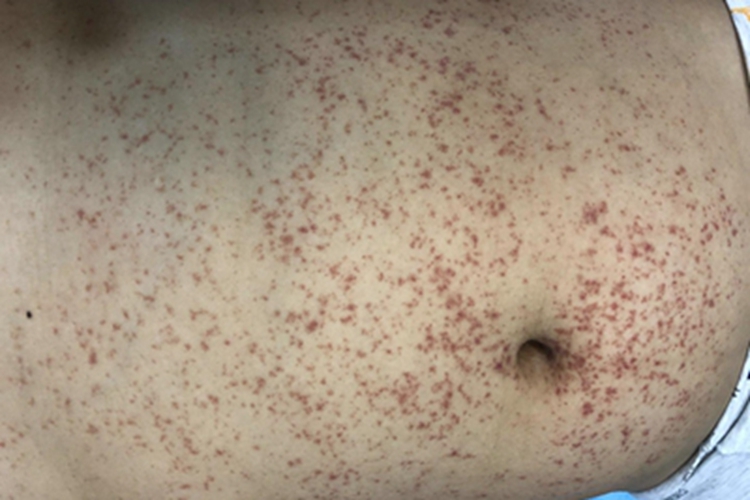 过敏性紫癜棕褐色斑丘疹图