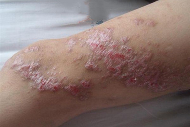 汗孔角化病大腿症状图